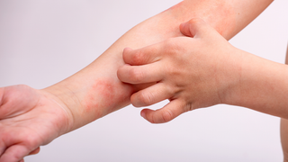 Natural Ways to Support Eczema-Prone Skin